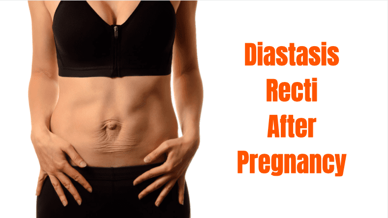 Featured image for “Diastasis Recti After Pregnancy”