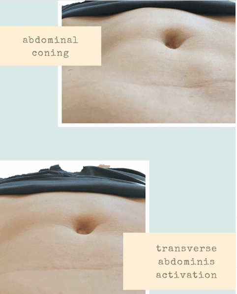 Diastasis Recti After Pregnancy