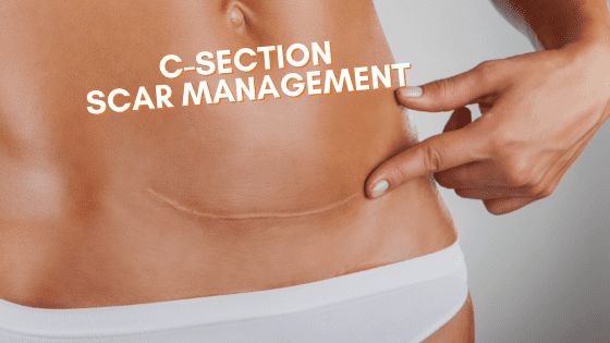 How to take care of C-section scars