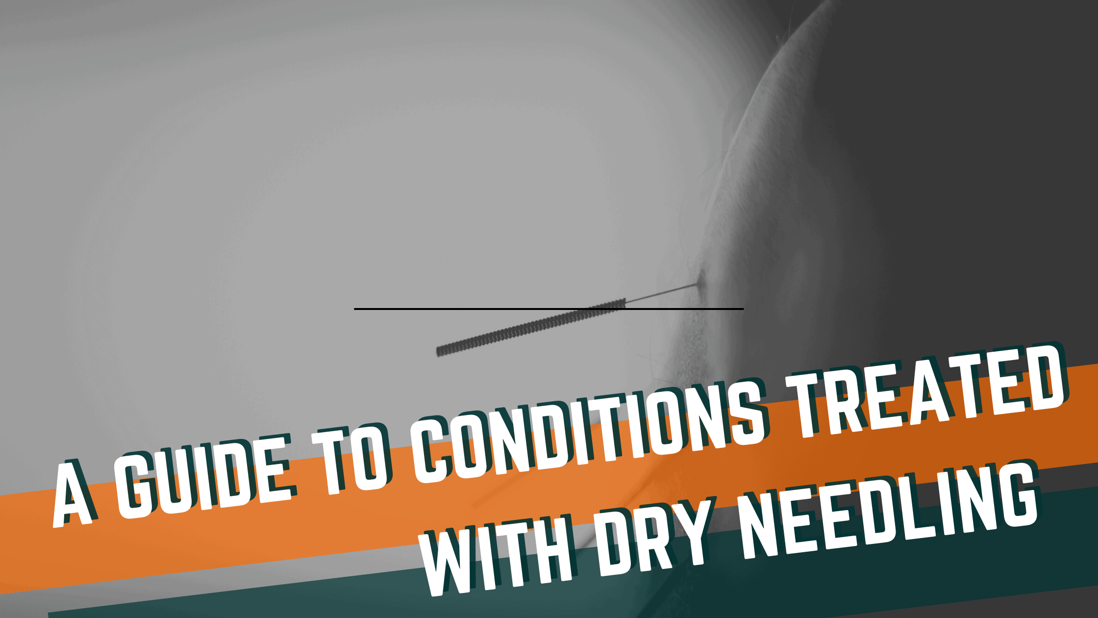 Featured image for “A Guide to Conditions Treated with Dry Needling”