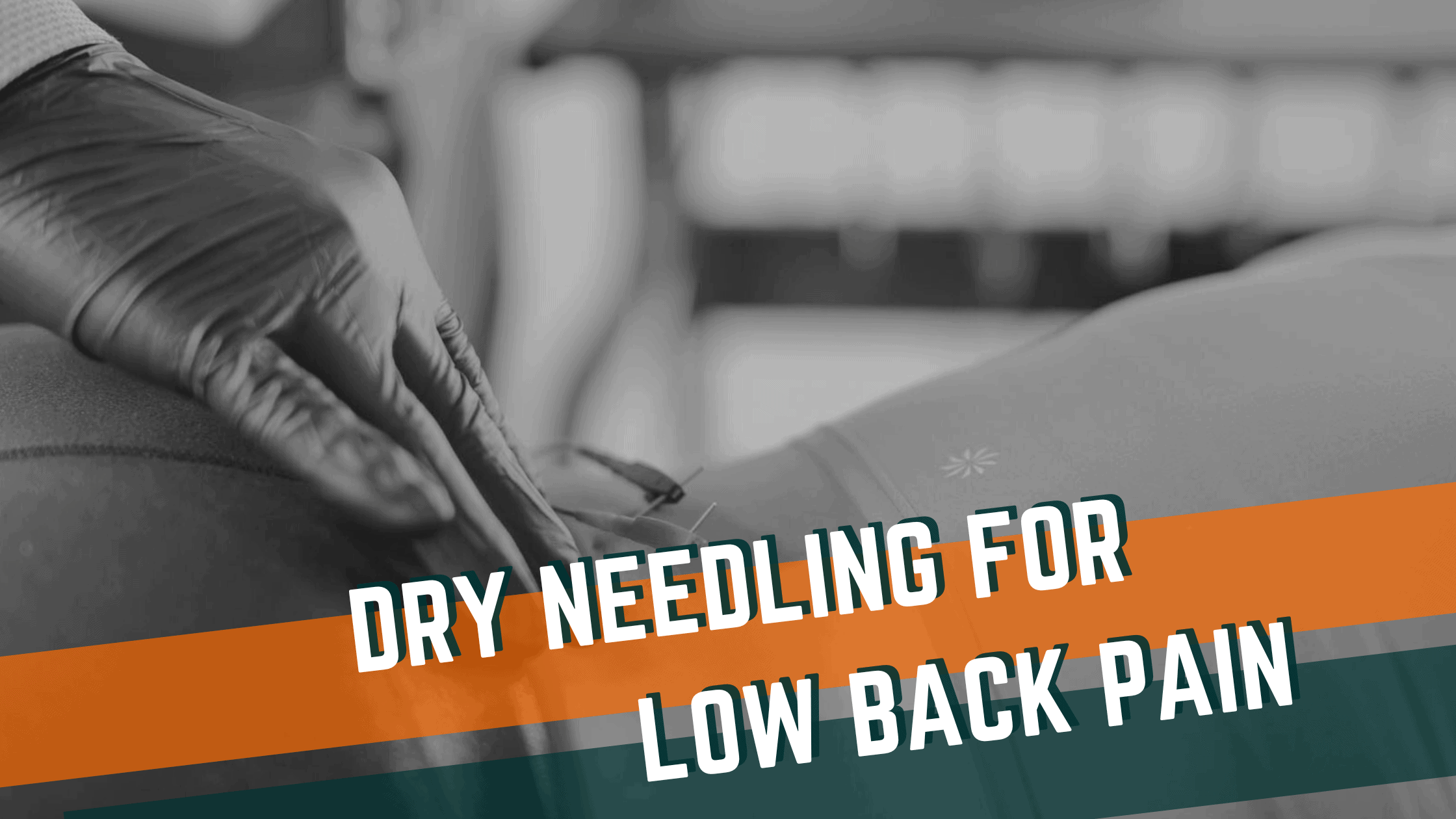 Dry Needling for Low Back Pain