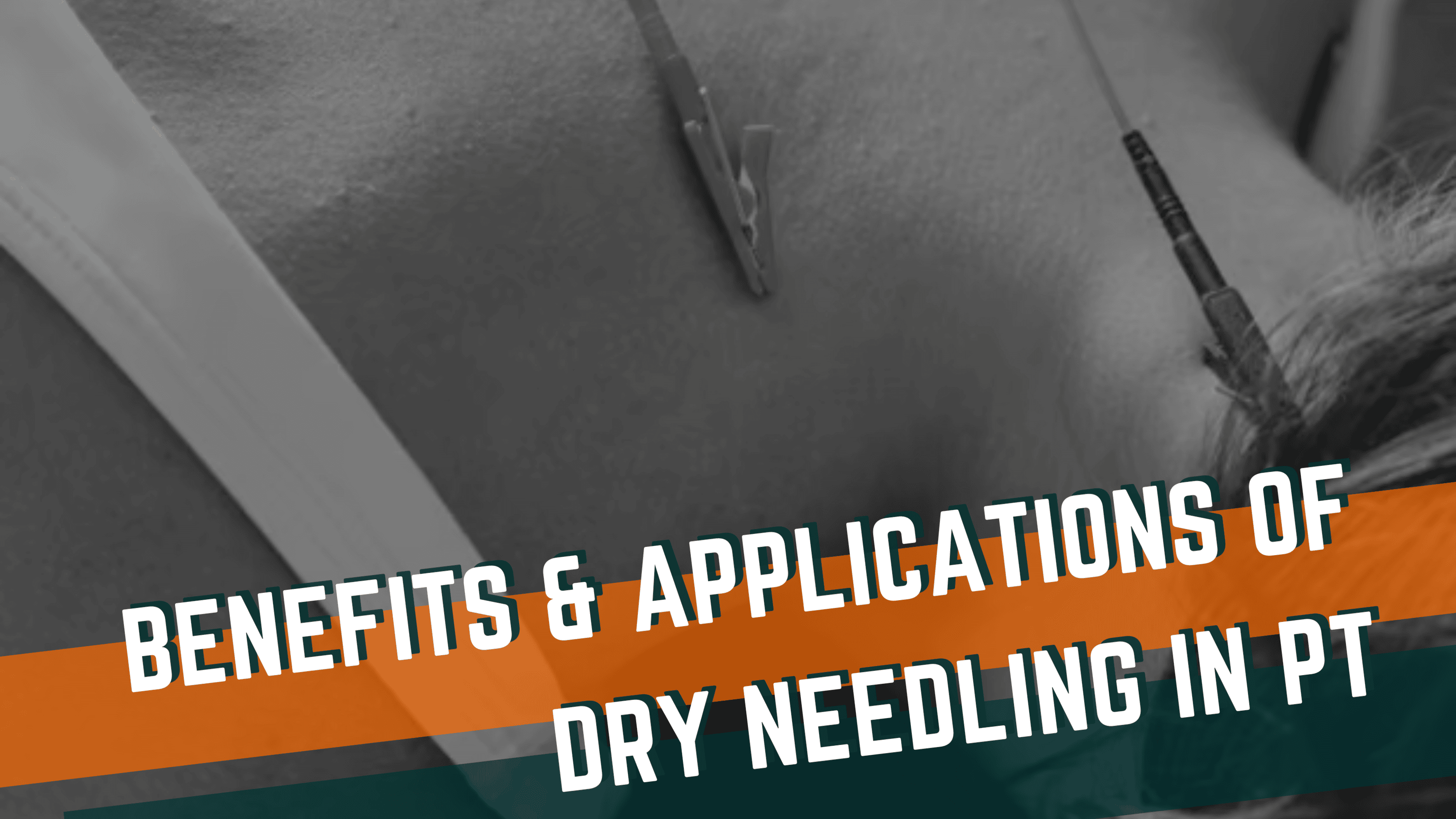 Featured image for “What is Dry Needling in Physical Therapy? Exploring the Benefits and Applications”