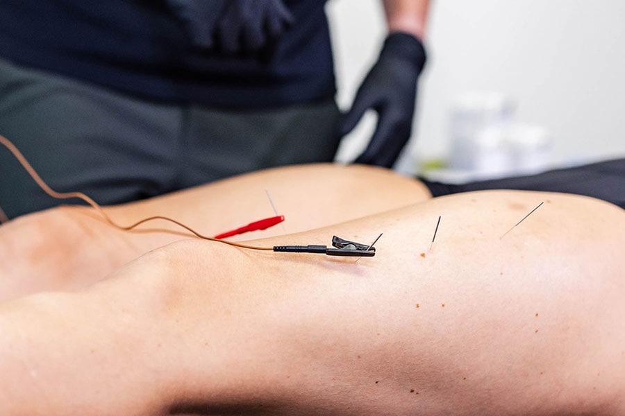 Dry-Needling